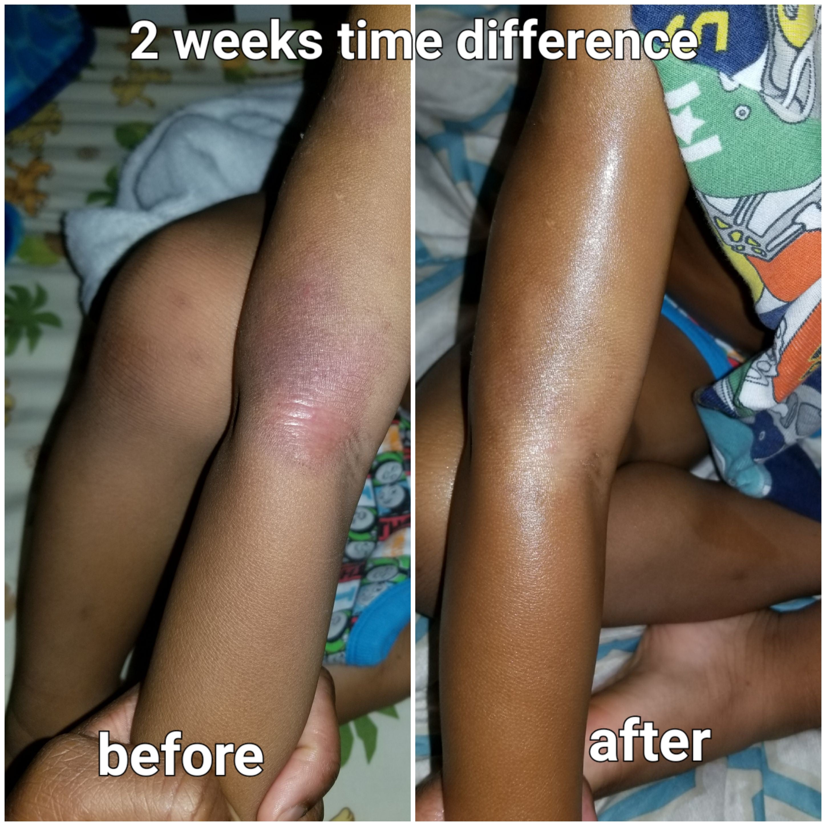 Before and after pic of eczema on a child arm using all natural products